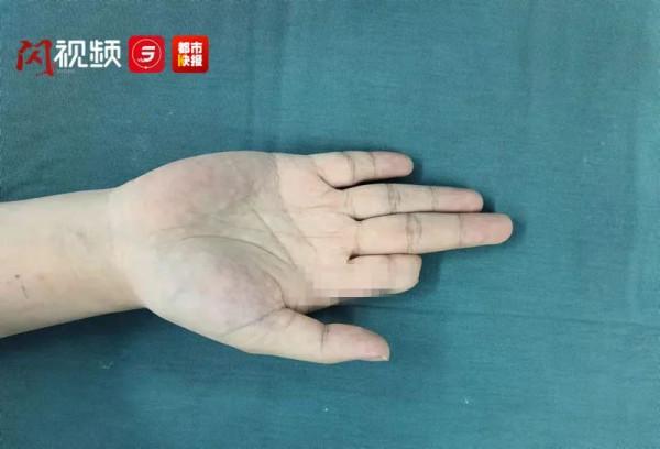 家長警惕!一根線頭令女嬰不幸截肢,20年後醫生為她再造手指 家長警惕!一根線頭令女嬰不幸截肢,20年後醫生為她再造手指