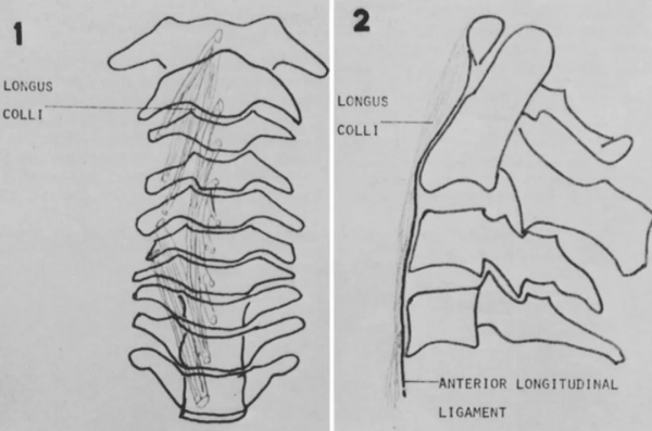 頸椎少見的3種鈣化性疾病 頸椎少見的3種鈣化性疾病