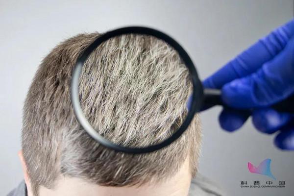 為什麼壓力大時會長白頭髮？這些習慣可能會催生白髮&hellip;