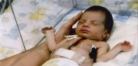 1984年,美國一女嬰移植狒狒心臟手術成功,女孩最後能不能活下去 1984年,美國一女嬰移植狒狒心臟手術成功,女孩最後能不能活下去