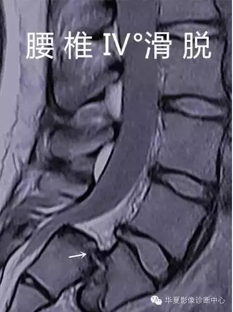 骶椎腰化/腰椎骶化、腰椎滑脫、腰肌勞損，簡單易懂圖解