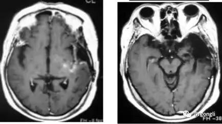硼中子俘獲治療BNCT 硼中子俘獲治療BNCT