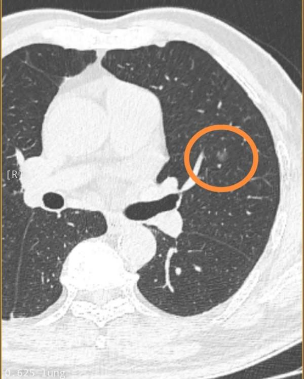 問診:兩肺多髮結節,不同形態,該儘早手術了嗎? 問診:兩肺多髮結節,不同形態,該儘早手術了嗎?