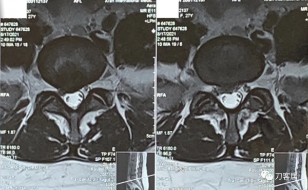 27歲女性，兩間隙腰椎間盤突出症，6顆釘子，4個融合器