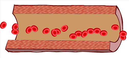 秋風蕭瑟,當心腦出血 秋風蕭瑟,當心腦出血
