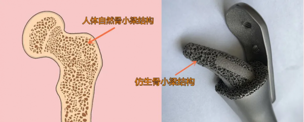 10歲女孩大腿疼一年多,醫生建議從大腿根處截肢 10歲女孩大腿疼一年多,醫生建議從大腿根處截肢