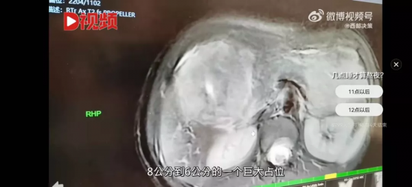 22歲女孩熬夜吃燒烤，切掉半個肝：不自律，真的會死