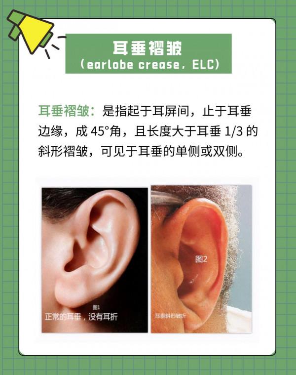 耳朵上有這條摺痕，就是冠心病、心梗的訊號？醫生告訴你真相