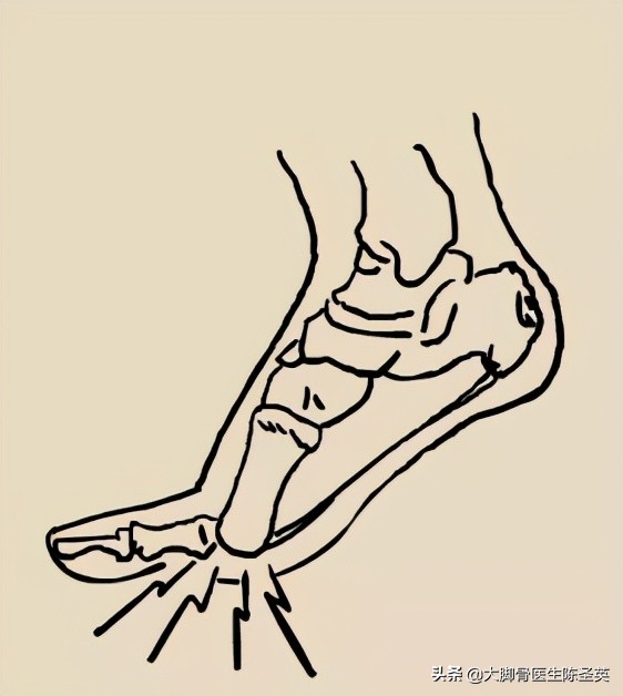 腳底板愛長繭子,走路疼痛到底是怎麼回事? 腳底板愛長繭子,走路疼痛到底是怎麼回事?