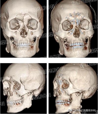 臉摔骨折要當心 早期修復很重要
