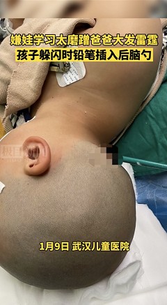 太嚇人！寫作業時父子起爭執，鉛筆竟插入8歲男孩後腦勺