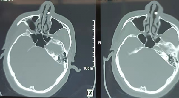 罕見！河北一男子鼻子里長了牙……