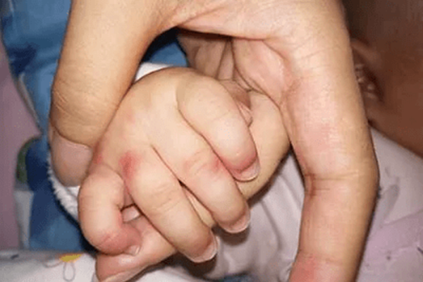 孩子高熱不退且關節紅腫，是類風溼的前兆？