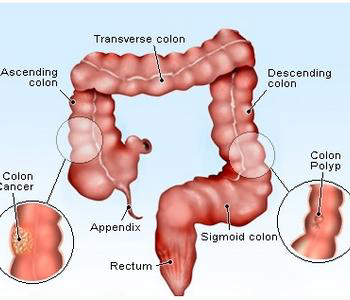 慢性結腸炎，保護腸道黏膜，減少慢性結腸炎反覆發作