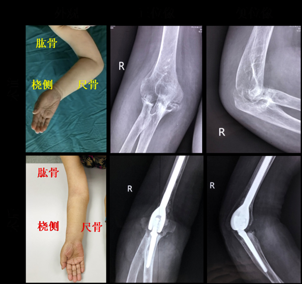 “不死的癌症”導致關節嚴重變形,一次手術後,她終於能抬手了 “不死的癌症”導致關節嚴重變形,一次手術後,她終於能抬手了
