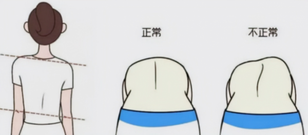 孩子高低肩、身子歪或許是半椎體畸形惹的禍，不要不當回事