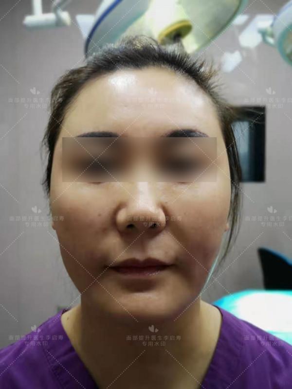 42歲做過三次線雕,法令紋、蘋果肌下垂、面部臃腫改善案例 42歲做過三次線雕,法令紋、蘋果肌下垂、面部臃腫改善案例
