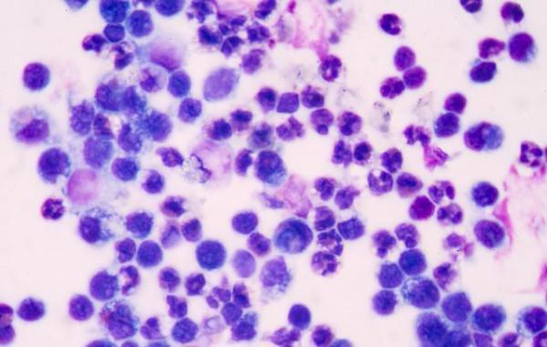 做血常規檢查，建議大家注意這3個指標，別忽視了