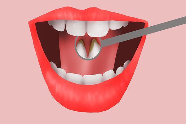 缺牙的朋友？是選擇烤瓷牙還是種植牙？補牙後的怎樣日常護理