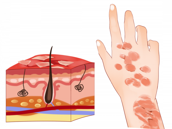 【受試者招募】銀屑病患者，這項臨床研究可關注一下~