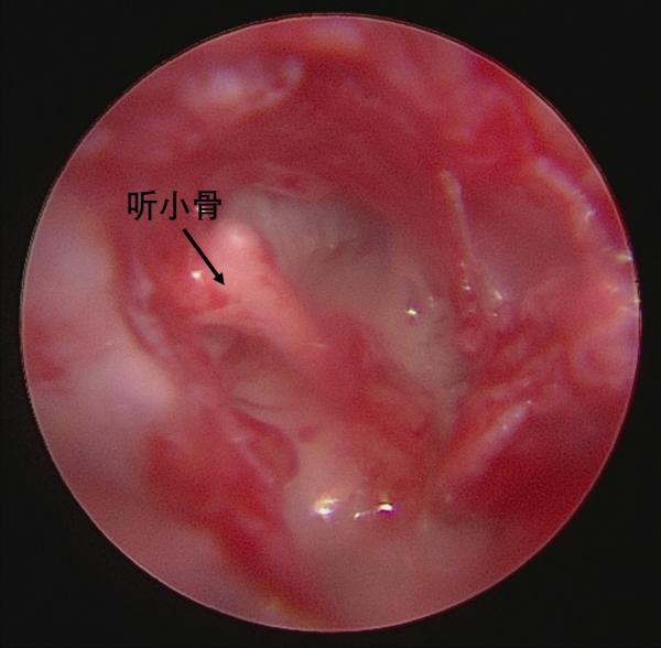 耳朵里長了個小珍珠 耳朵里長了個小珍珠