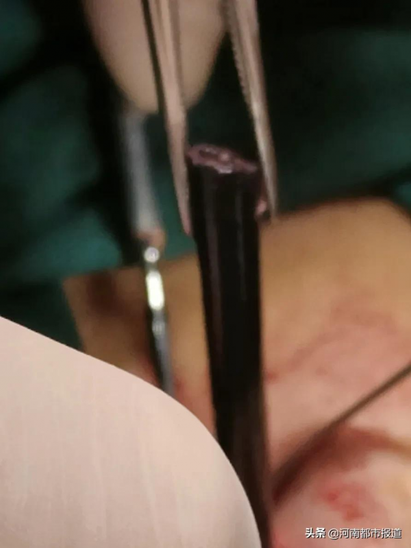 京豫專家聯手，取出男孩顱內一根筷子