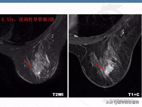 乳腺T2WI高訊號腫瘤病變的診斷思路 乳腺T2WI高訊號腫瘤病變的診斷思路