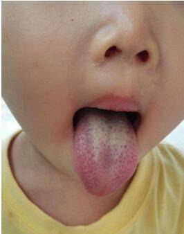 幾種常見的小兒舌象，家長們要多多注意了