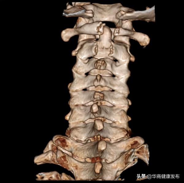 頸部疼痛不適長達11年，本以為是頸椎病，沒想到竟是先天性疾病……