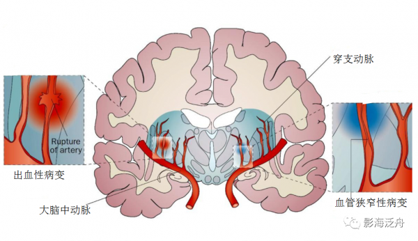 VR腔隙、腔梗灶、微出血、脫髓鞘，傻傻分不清？快看這裡