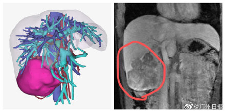 22歲女生查出是乙肝攜帶者，仍長期熬夜吃燒烤三年後罹患肝癌