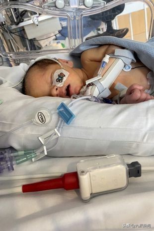 英國寶寶出生時腸子長在體外 已手術成功出院 父母取名“勇士”