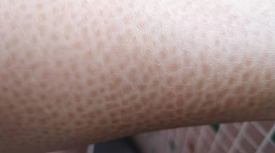 這2種皮膚疾病，無法被根治，但可以透過治療緩解