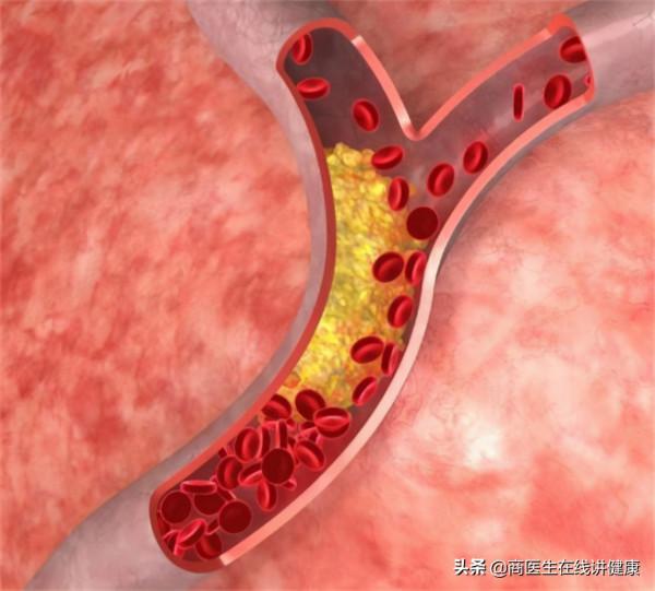 有高血壓的人要注意了，醫生：出現這3種狀況當心腦出血，要警惕