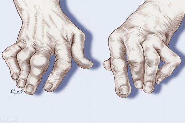 痛風、關節紅腫熱痛？四味中藥，清熱消腫止痛，有效調理