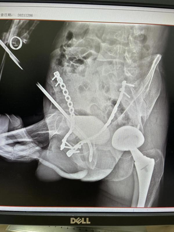 名醫札記（105）重大突破！“套筒穿刺導航+內切開術”現世