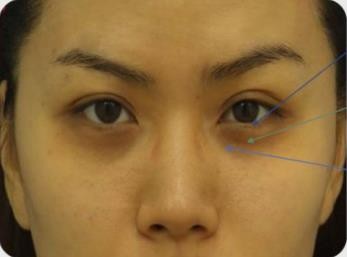 53歲陳紅聚會近照曝光，雙目無神顯疲態：3招讓你的眼睛會說話