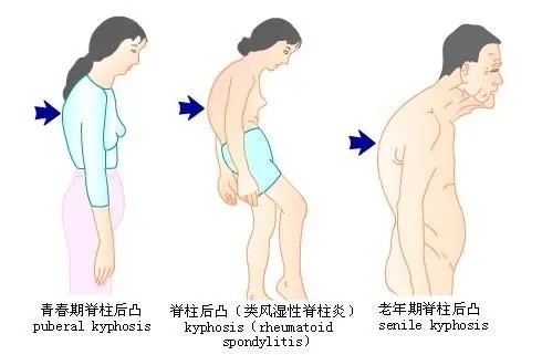 腰椎後凸畸形是怎麼回事？這種情況嚴重嗎？需要手術嗎？