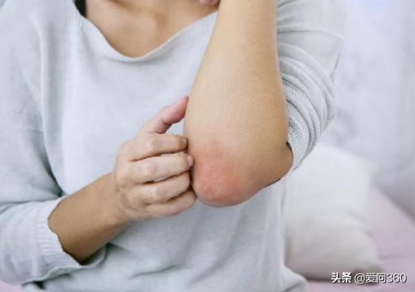 溼疹癢得難受,小妙招幫你解憂,告別反覆發作的溼疹 溼疹癢得難受,小妙招幫你解憂,告別反覆發作的溼疹