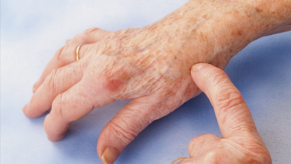 痛風不痛就是病好了嗎？這3個降尿酸的方法，可能比吃藥都有效