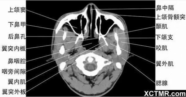 頭頸五官CT斷層解剖圖及常見病影像診斷