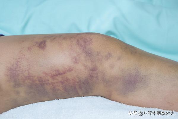 色斑,老年斑,嘴唇黑,胸口刺痛疼?血府逐瘀,活血化瘀,氣血旺 色斑,老年斑,嘴唇黑,胸口刺痛疼?血府逐瘀,活血化瘀,氣血旺