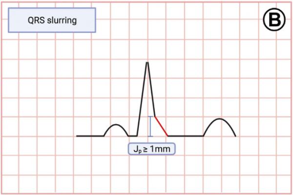 早期復極都是正常的嗎?一場驚險的心跳驟停帶來的啟示 早期復極都是正常的嗎?一場驚險的心跳驟停帶來的啟示