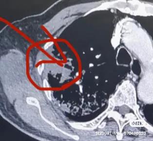 氬氦刀冷凍活檢隨訪篇