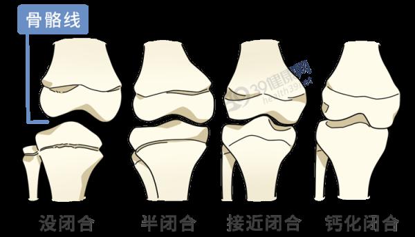 花了家裡16萬切斷雙腿骨頭,只為增高7.2釐米,如今與後遺症為伴 花了家裡16萬切斷雙腿骨頭,只為增高7.2釐米,如今與後遺症為伴