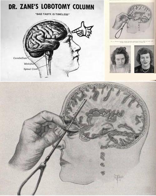 30萬人永無休止的噩夢!1949年的醫學獎:諾貝爾獎史上最大恥辱 30萬人永無休止的噩夢!1949年的醫學獎:諾貝爾獎史上最大恥辱