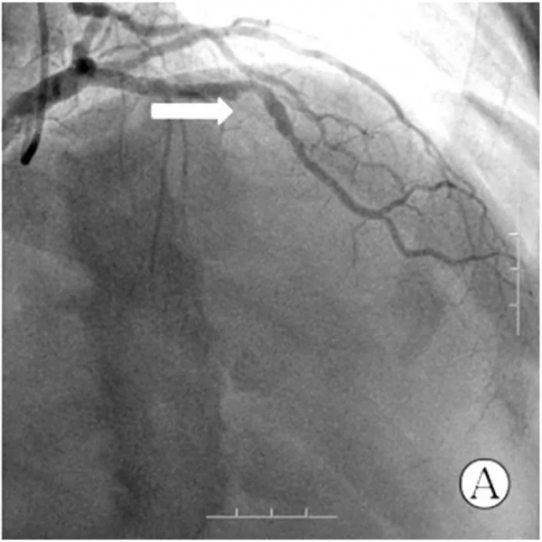 病例分享——前壁心肌梗死伴慢性腎臟病患者急診PCI中血運重建