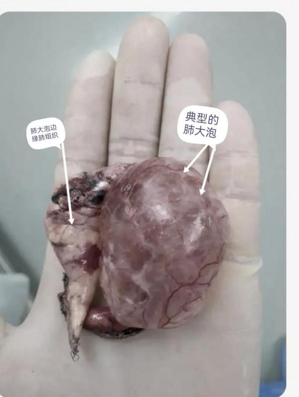 肺大泡相關（診治）問題