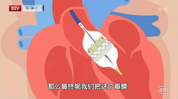 高血壓“突然正常”,別急著高興!很有可能是這種致命危機 高血壓“突然正常”,別急著高興!很有可能是這種致命危機