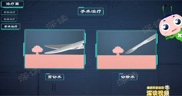 藥物腐蝕？液氮冷凍？鐳射灼燒？到底誰才能根治尖銳溼疣？